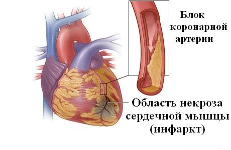 Колит сердце: причины и диагностика боли