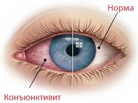 Красные глаза: причины и лечение