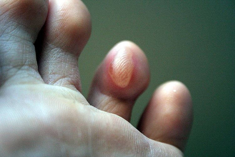 Места пальчика. Мазолм на прдушечках пальцев ног.