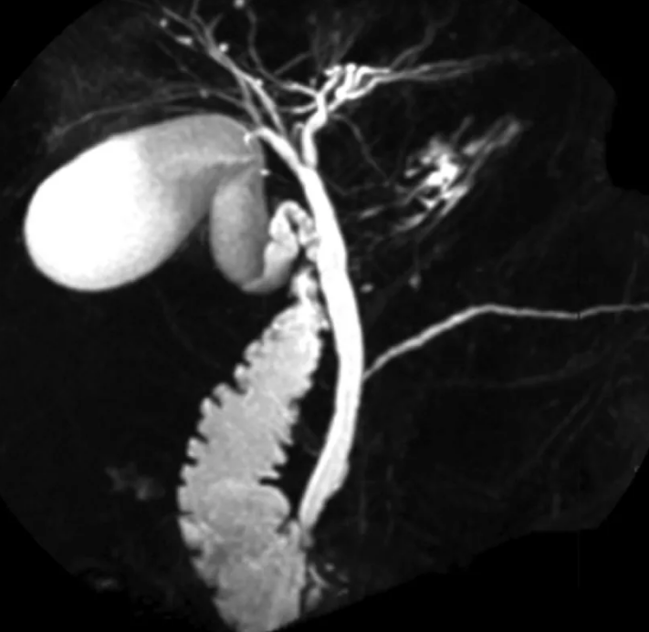 Фото желчных протоков