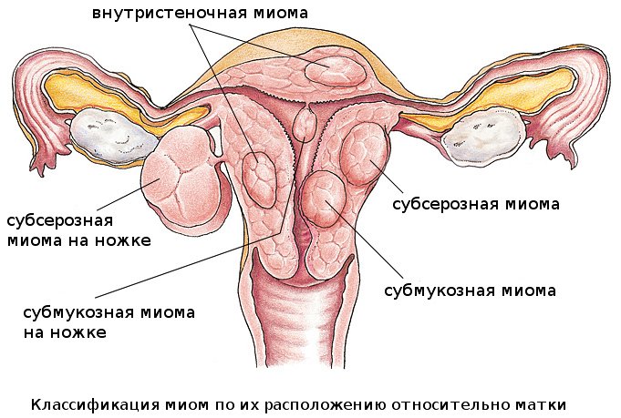 Боровая матка при эндометриозе, бесплодии и миоме